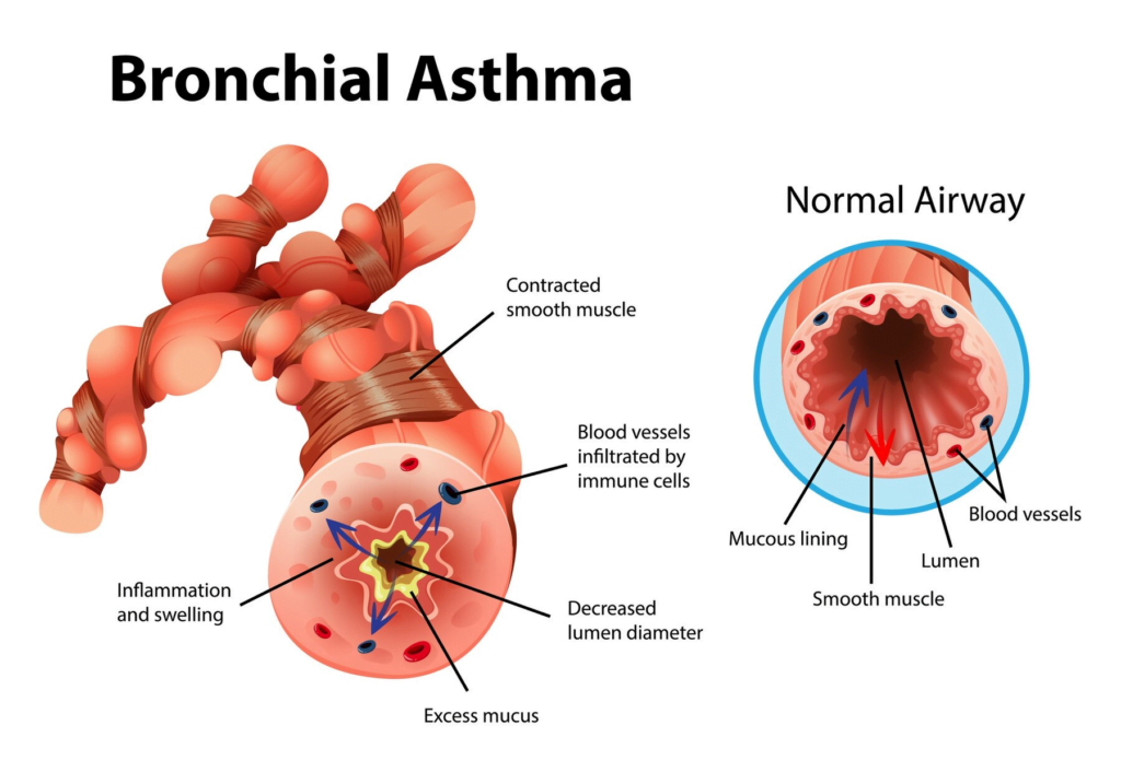 Illustration of Asthma inflamed bronchial tube (importance of spirometry in asthma management)