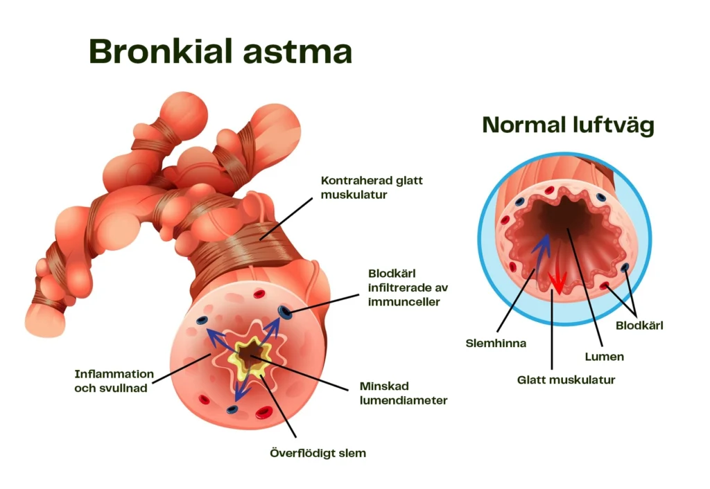 spirometri för astma diagnos